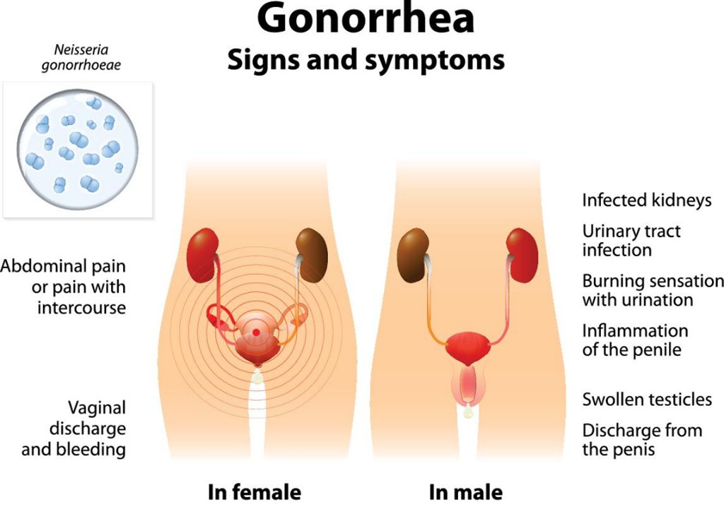 Gonorrhea